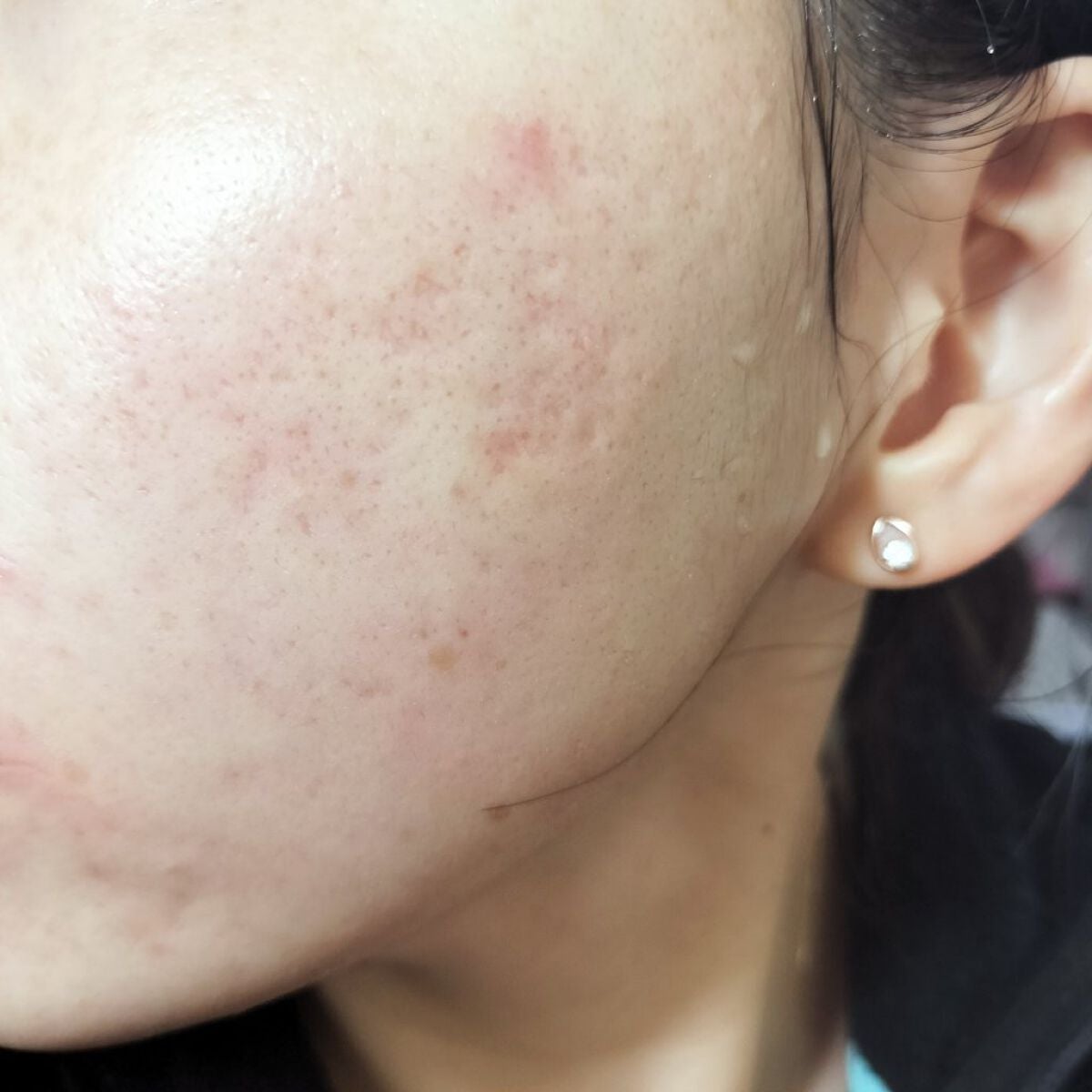 miina@汚肌工事録⚠️ on LIPS 「✍12/3の#汚肌工事録ありがとう💕きょうもおつかれさまだよ😂..」(2枚目)