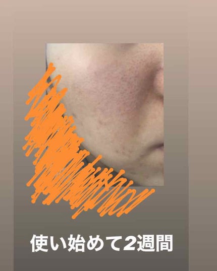 薬用 しみ 集中対策 美容液/メラノCC/美容液を使ったクチコミ(3枚目)