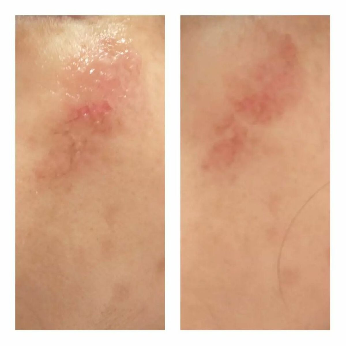 あにゃにゃ♡フォロバ100♡ on LIPS 「22日(先週日曜日)のピコスポット経過です☺️🙌場所→左頬目の..」(1枚目)