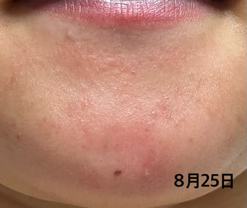 ささ on LIPS 「【ニキビが一個でも病院に行きましょう!】ニキビは尋常性ざ瘡とい..」(3枚目)