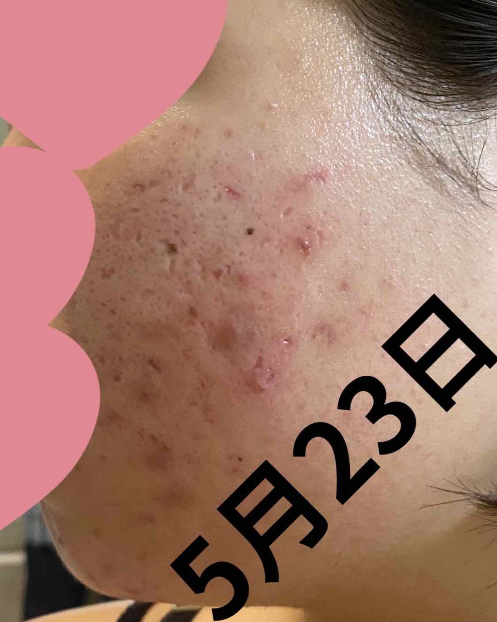 ! on LIPS 「皮膚科処方薬約2週間経過にきびはまだまだ残ってます😭でも!!鼻..」(1枚目)