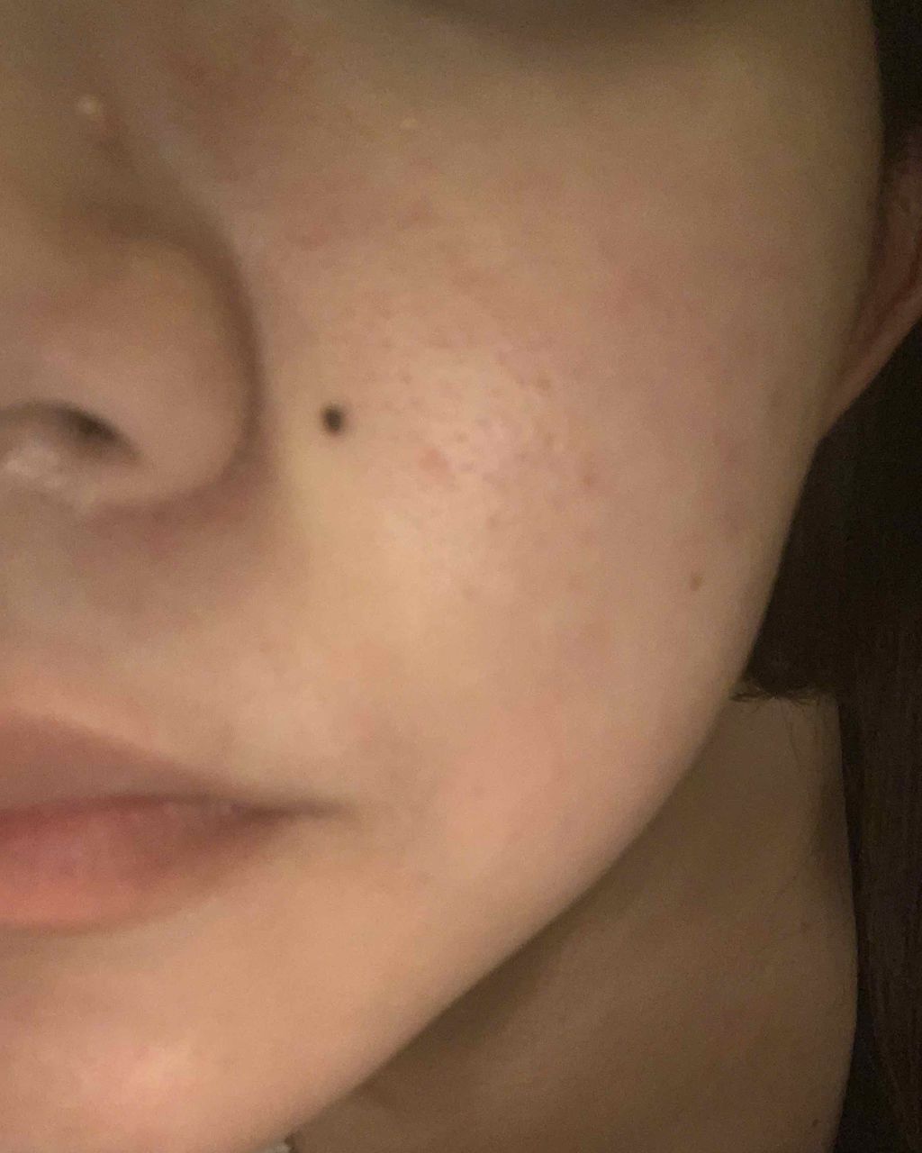 ︎︎︎︎︎☺︎︎︎︎︎︎☺︎︎︎︎︎︎☺︎ on LIPS 「前の投稿から1ヶ月後くらいになったので経過報告!!ん〜多少は治..」(4枚目)