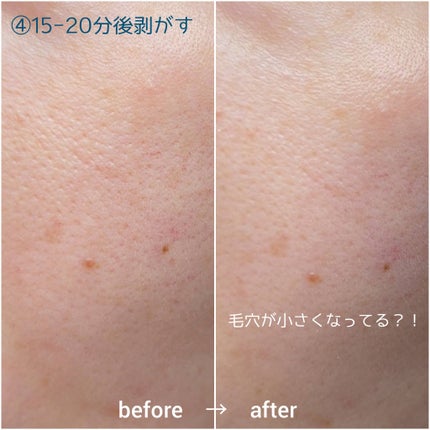 リードルショットEX ヒアルロニックモデリングパック/VT/シートマスク・パックを使ったクチコミ(6枚目)