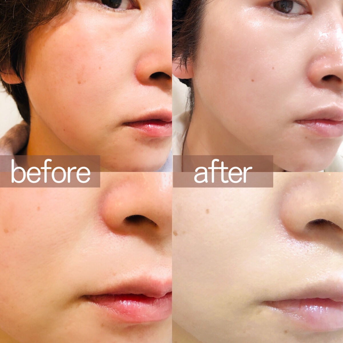 二重になる方法》AGE-R専用ジェルセラム｜MEDICUBEの使い方や二重