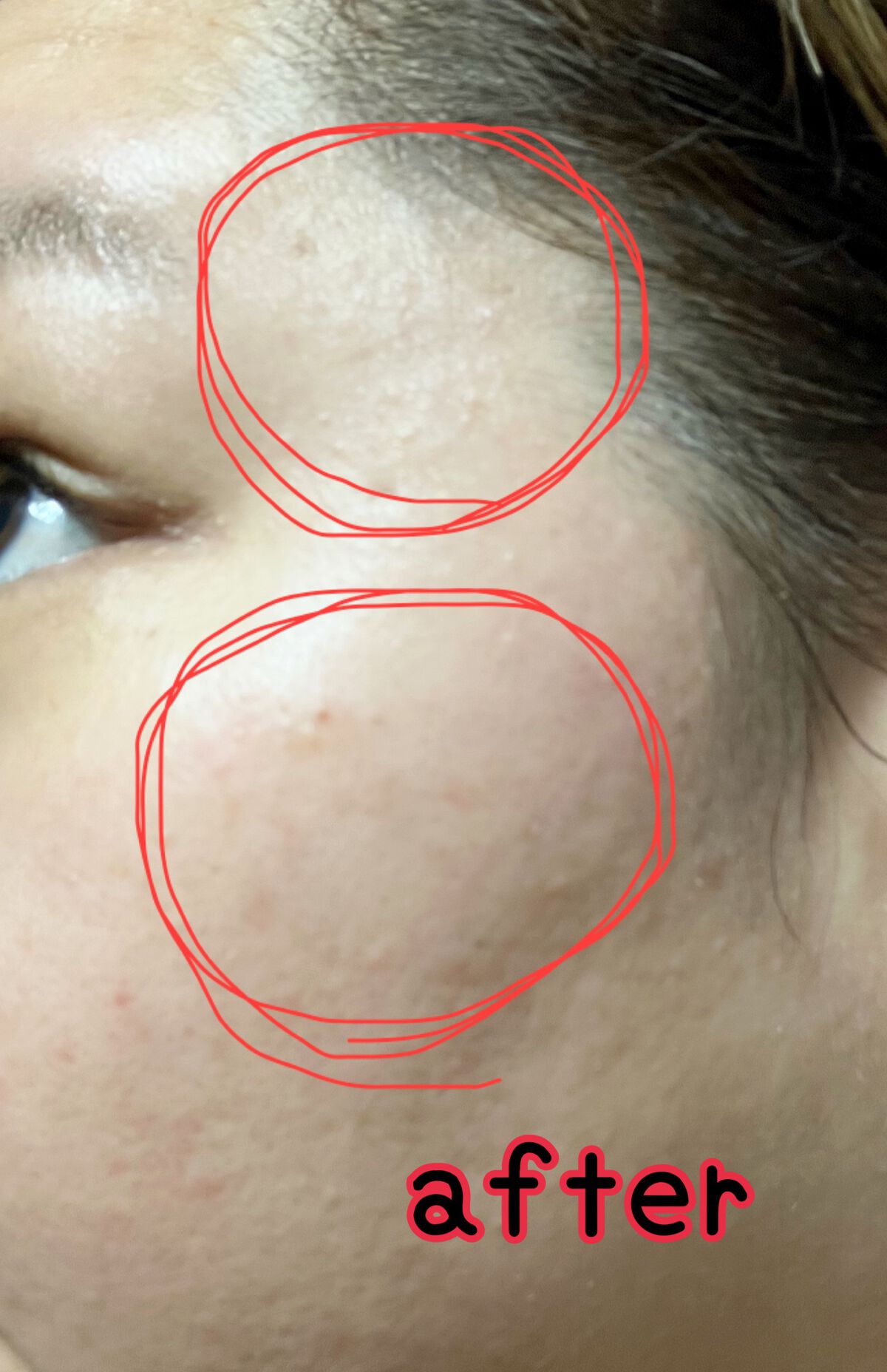 エファクラ ピールケア セラム/ラ ロッシュ ポゼ/美容液を使ったクチコミ(5枚目)