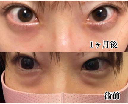 【旧】ディオールスキン フォーエヴァー スキン コレクト コンシーラー/Dior/リキッドコンシーラーを使ったクチコミ(6枚目)