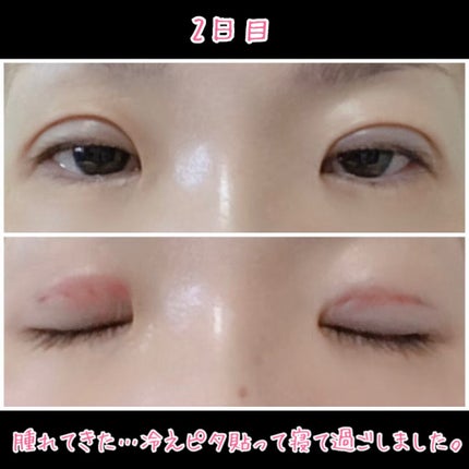 二重整形/その他を使ったクチコミ(3枚目)