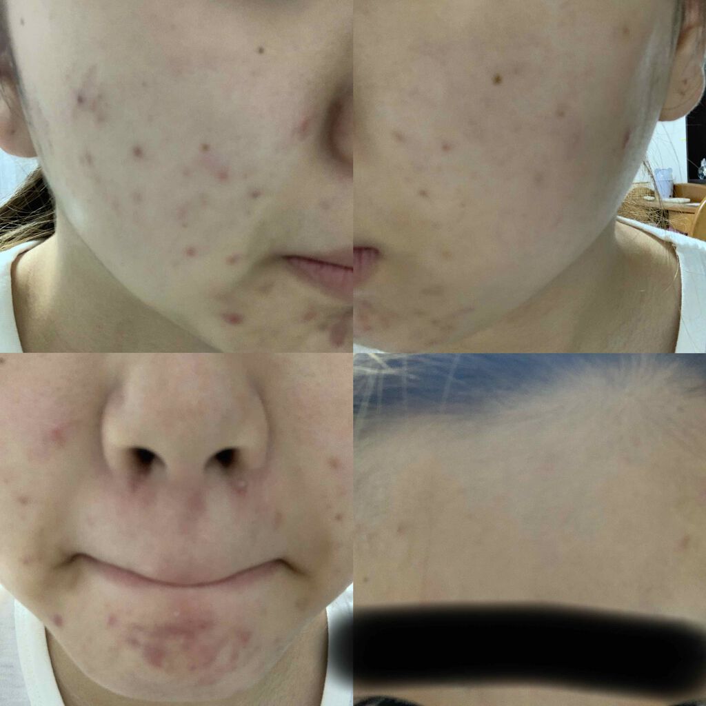 yuu on LIPS 「汚い肌を失礼します💧🙇♀️🙇♀️無加工でこの肌です😭😭ニキ..」(2枚目)