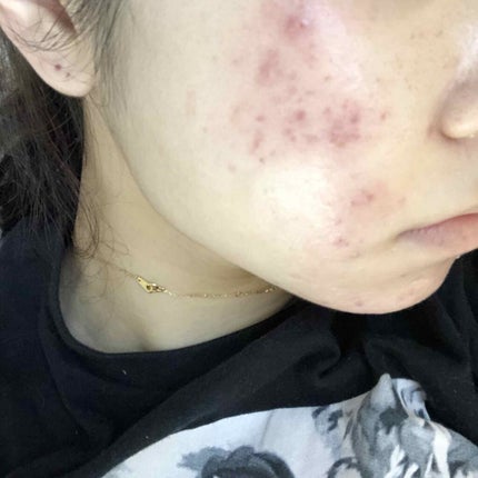 エピデュオゲル/マルホ株式会社/その他を使ったクチコミ(2枚目)