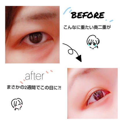 のびーるアイテープ(絆創膏タイプ、レギュラー)/DAISO/二重まぶた用アイテムを使ったクチコミ(2枚目)