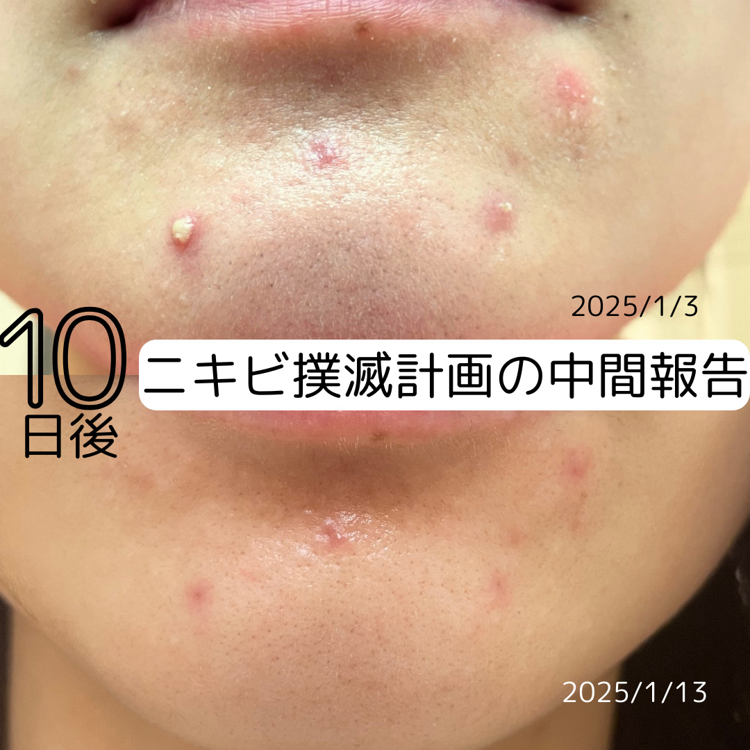 CHOI薬用マスク ニキビケア ［医薬部外品］/肌美精/シートマスク・パックを使ったクチコミ（1枚目）