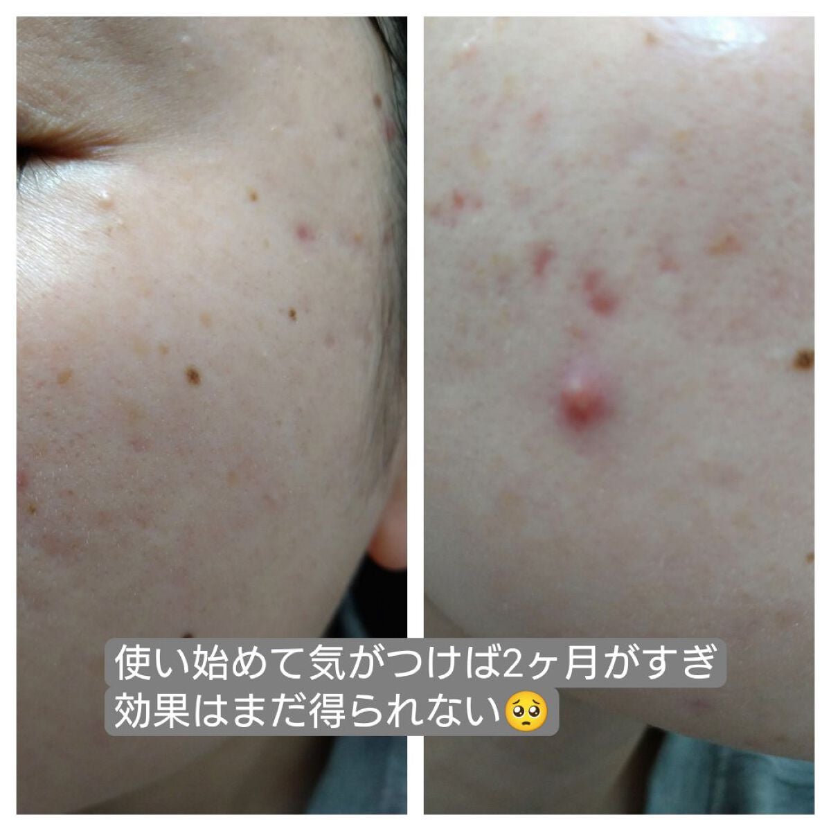 薬用 しみ 集中対策 美容液/メラノCC/美容液を使ったクチコミ(4枚目)