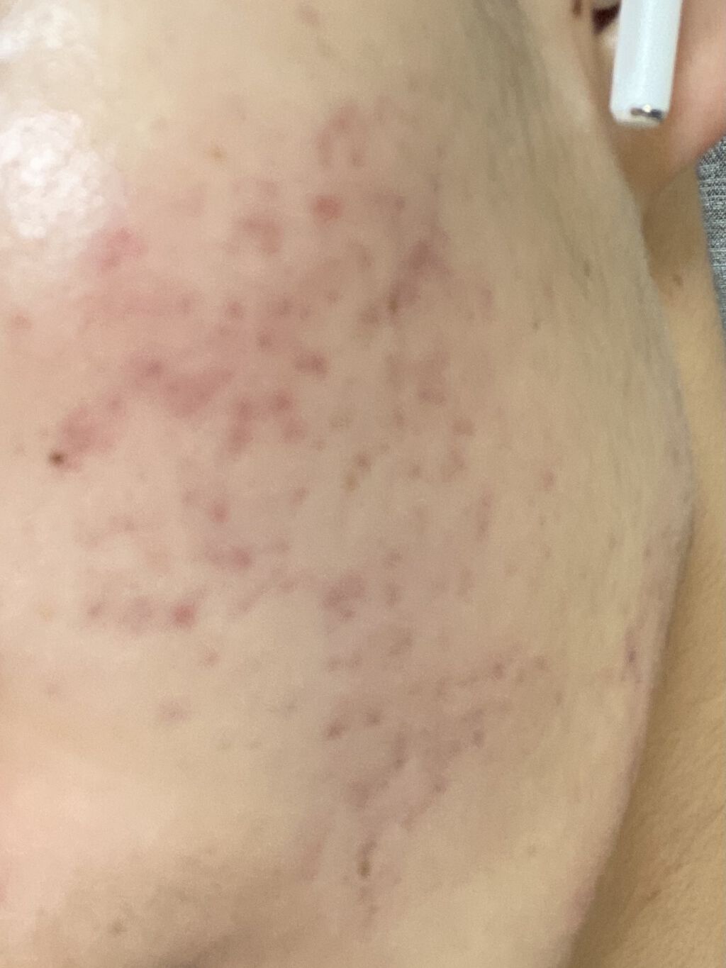 ビーソフテン ローション(医薬品)/持田製薬/その他を使ったクチコミ（2枚目）