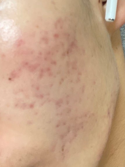 ビーソフテン ローション(医薬品)/持田製薬/その他を使ったクチコミ(2枚目)