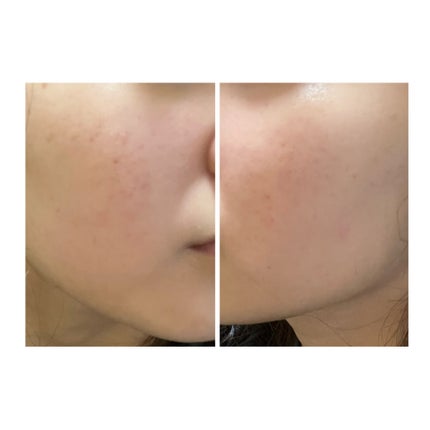 ぽむ on LIPS 「2023.9.13皮膚科に受診 エピデュオとヘパリン処方1枚目..」(4枚目)