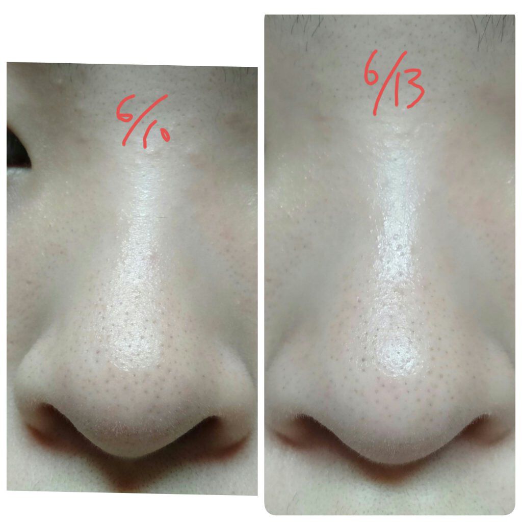 ティーツリーケア ソリューション エッセンシャルマスクEX/MEDIHEAL/シートマスク・パックを使ったクチコミ（3枚目）