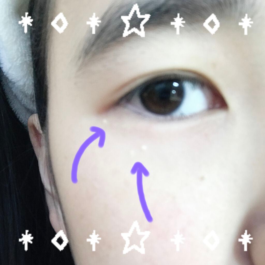 fantastic_rouge_s6b on LIPS 「初投稿です🤗質問なのですが。目の下にある白いポツポツが数ヶ月前..」(1枚目)