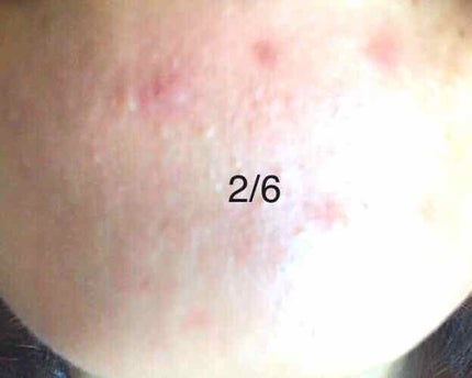 薬用クリーム/ニキビケア/フェイスクリームを使ったクチコミ(5枚目)