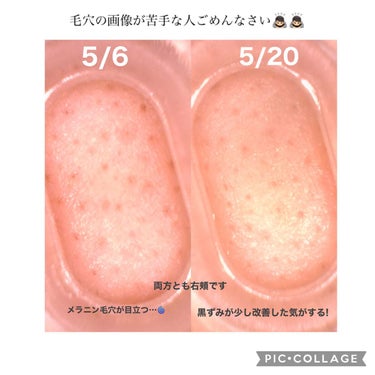 薬用しみ対策 美白化粧水/メラノCC/化粧水を使ったクチコミ（2枚目）