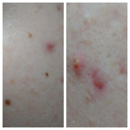 薬用 しみ 集中対策 美容液/メラノCC/美容液を使ったクチコミ(3枚目)