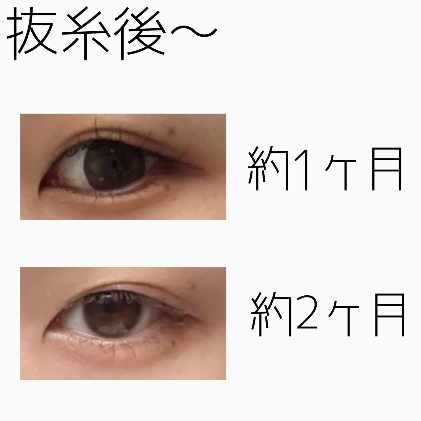 NANO@フォロバ! on LIPS 「二重整形ダウンタイム記録/抜糸してから半年が経ちました。約1ヶ..」(2枚目)