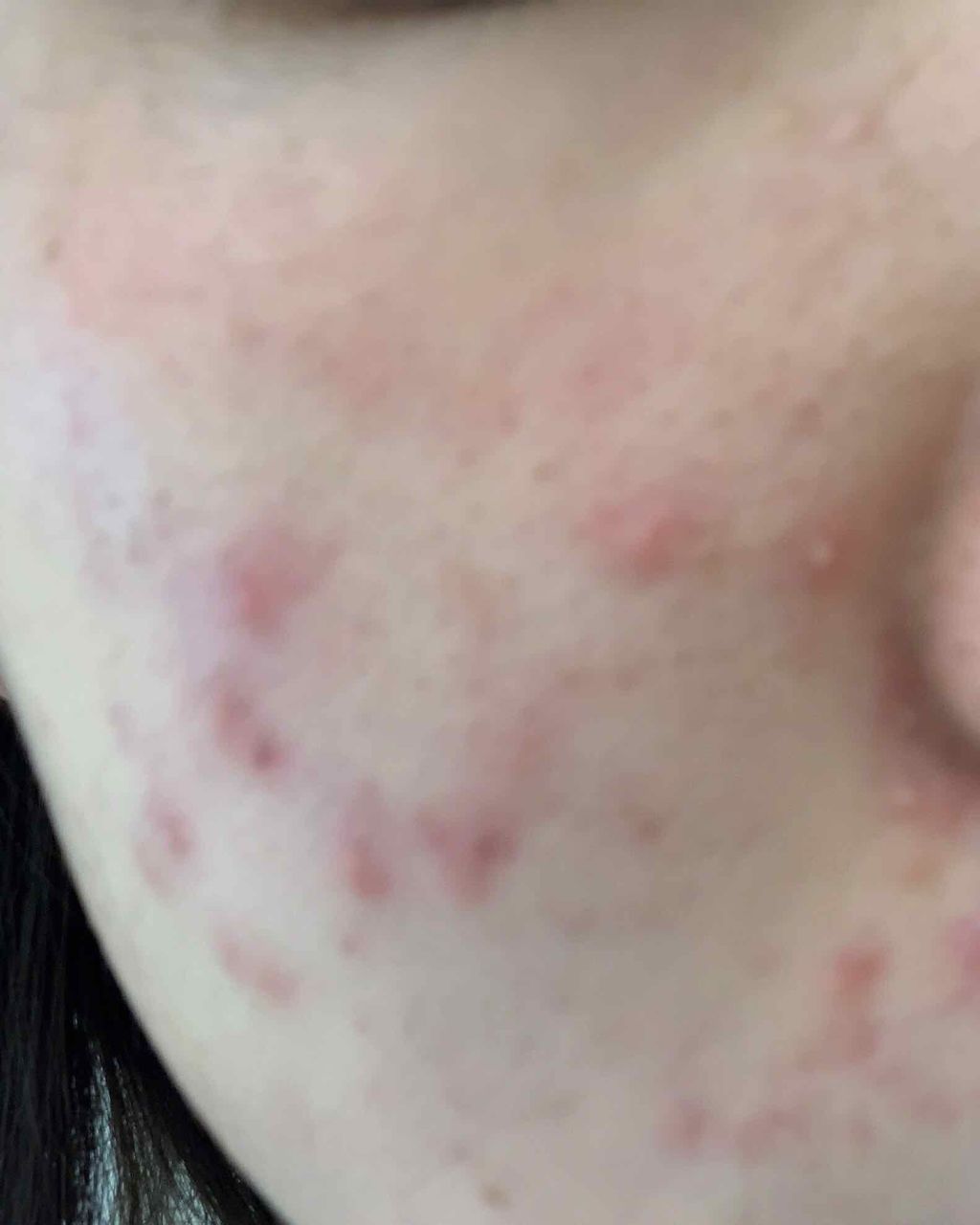 ベトネベートn軟膏 医薬品 第一三共ヘルスケアの口コミ あれ ちょっとニキビ薄くなった 2枚目か By 混合肌 10代前半 Lips