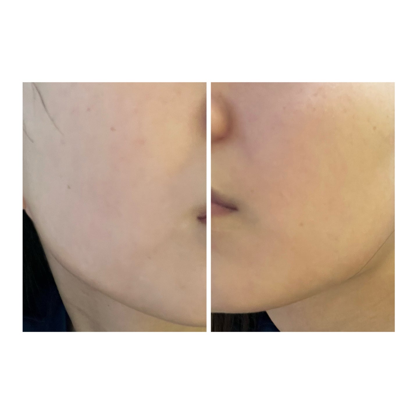 ぽむ on LIPS 「2023.9.13皮膚科に受診 エピデュオとヘパリン処方1枚目..」(4枚目)