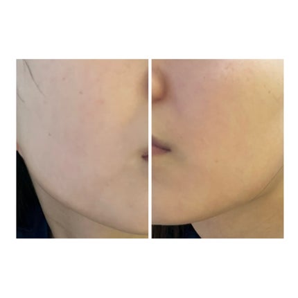 ぽむ on LIPS 「2023.9.13皮膚科に受診 エピデュオとヘパリン処方1枚目..」(4枚目)