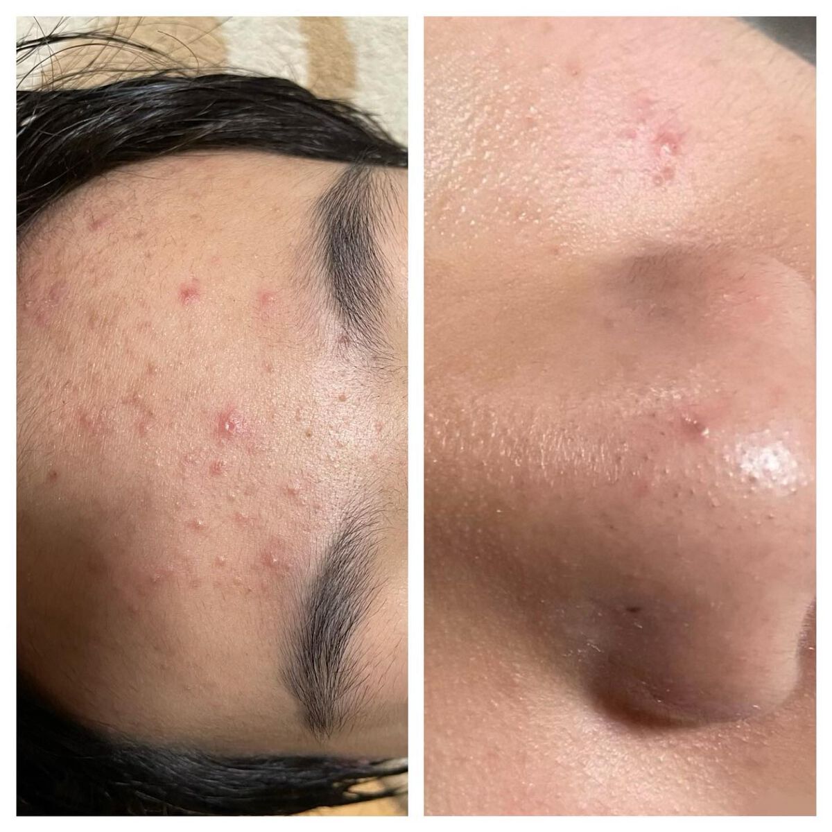 ベーシックセット(薬用)30日サイズ/プロアクティブ/スキンケアキットを使ったクチコミ(1枚目)