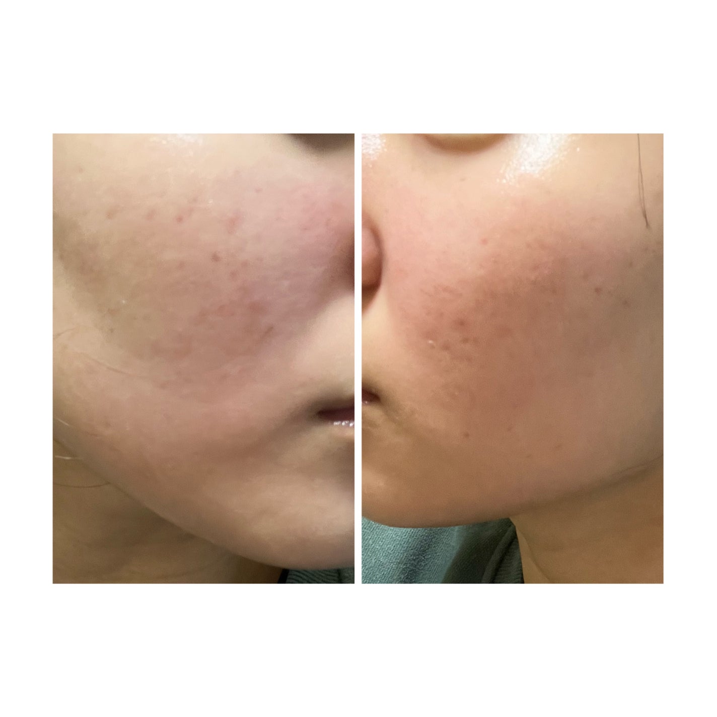 ぽむ on LIPS 「2023.9.13皮膚科に受診 エピデュオとヘパリン処方1枚目..」(2枚目)