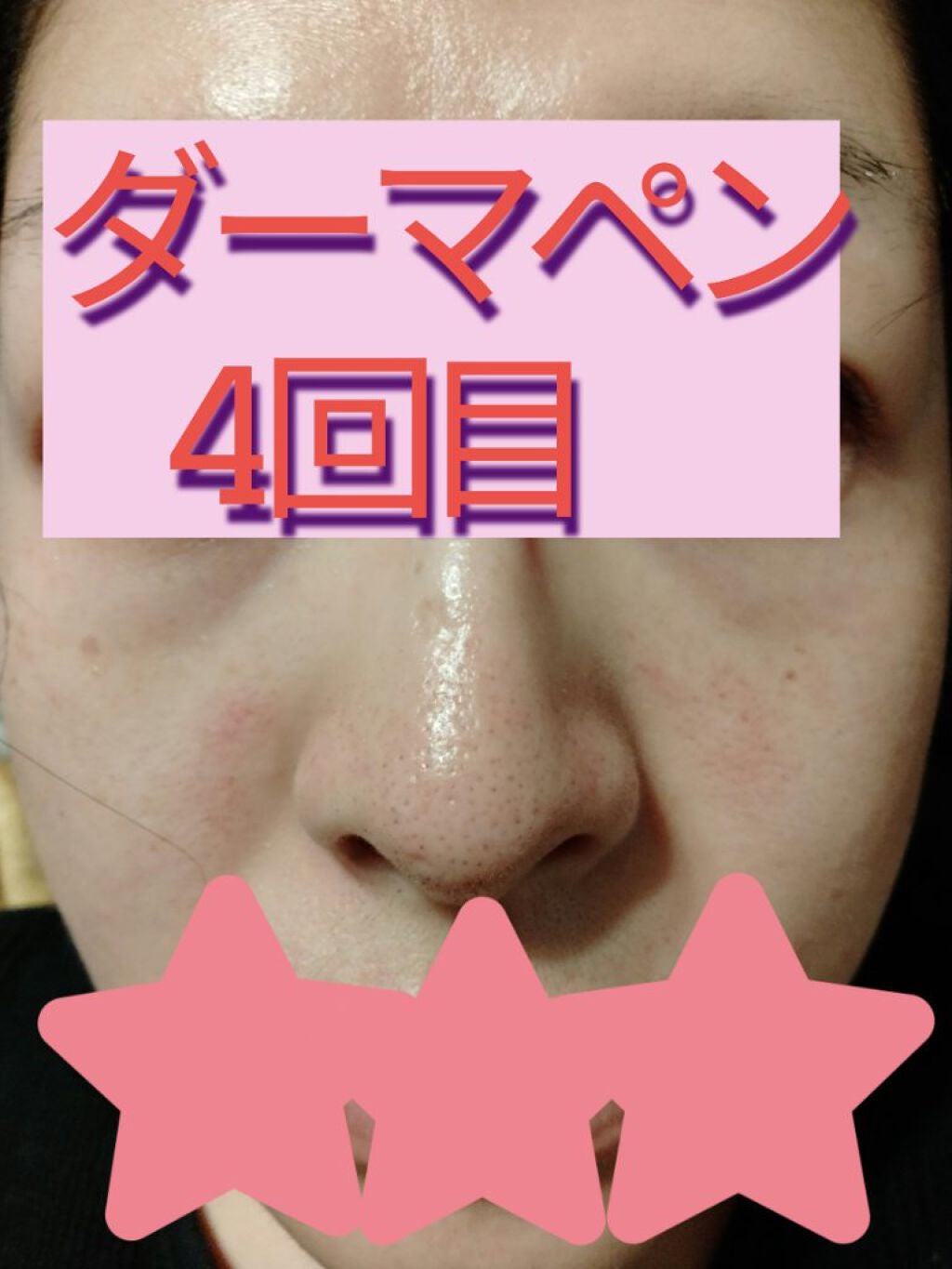 ダーマペン・ダーマスタンプ/MyM/その他スキンケアグッズを使ったクチコミ(1枚目)