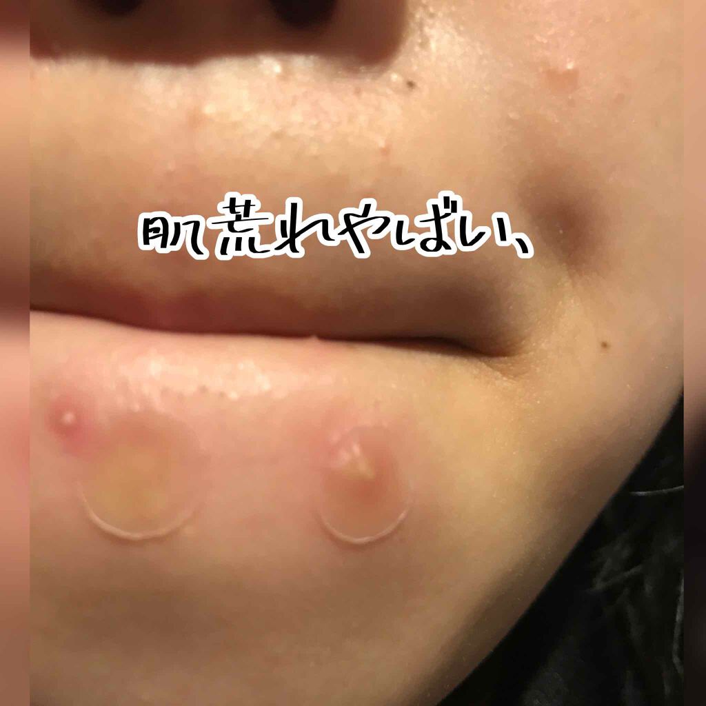 ゼロスポットパッチ/Today’s Cosme/にきびパッチを使ったクチコミ(2枚目)