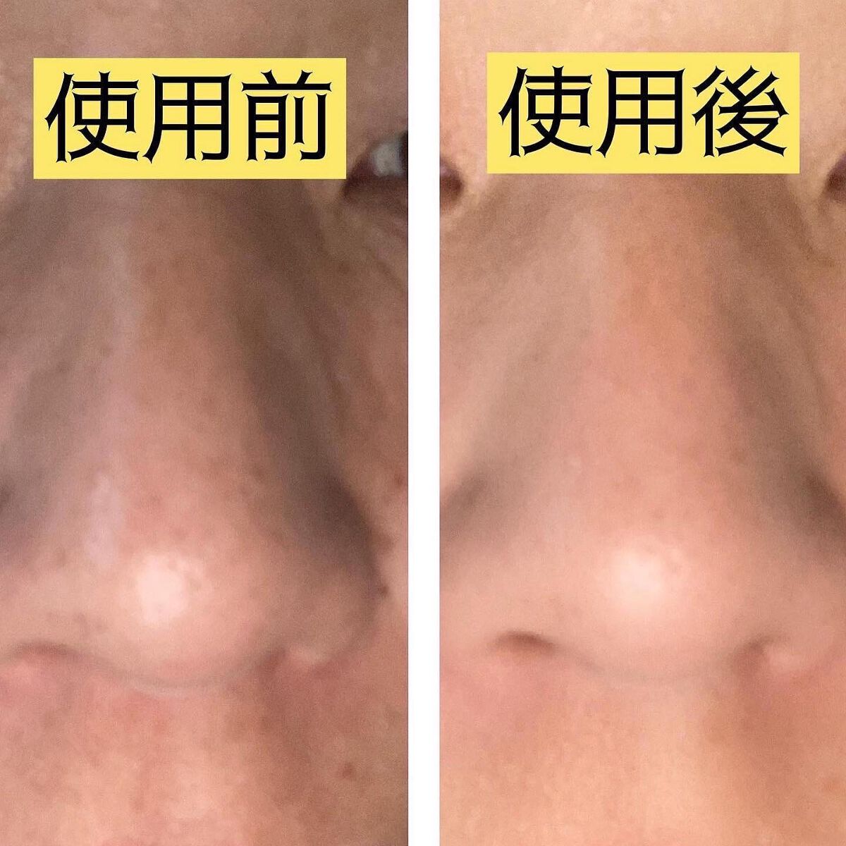 pikopiko on LIPS 「大人のニキビに@nikipita.official100人いれ..」(8枚目)