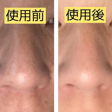 pikopiko on LIPS 「大人のニキビに@nikipita.official100人いれ..」(8枚目)