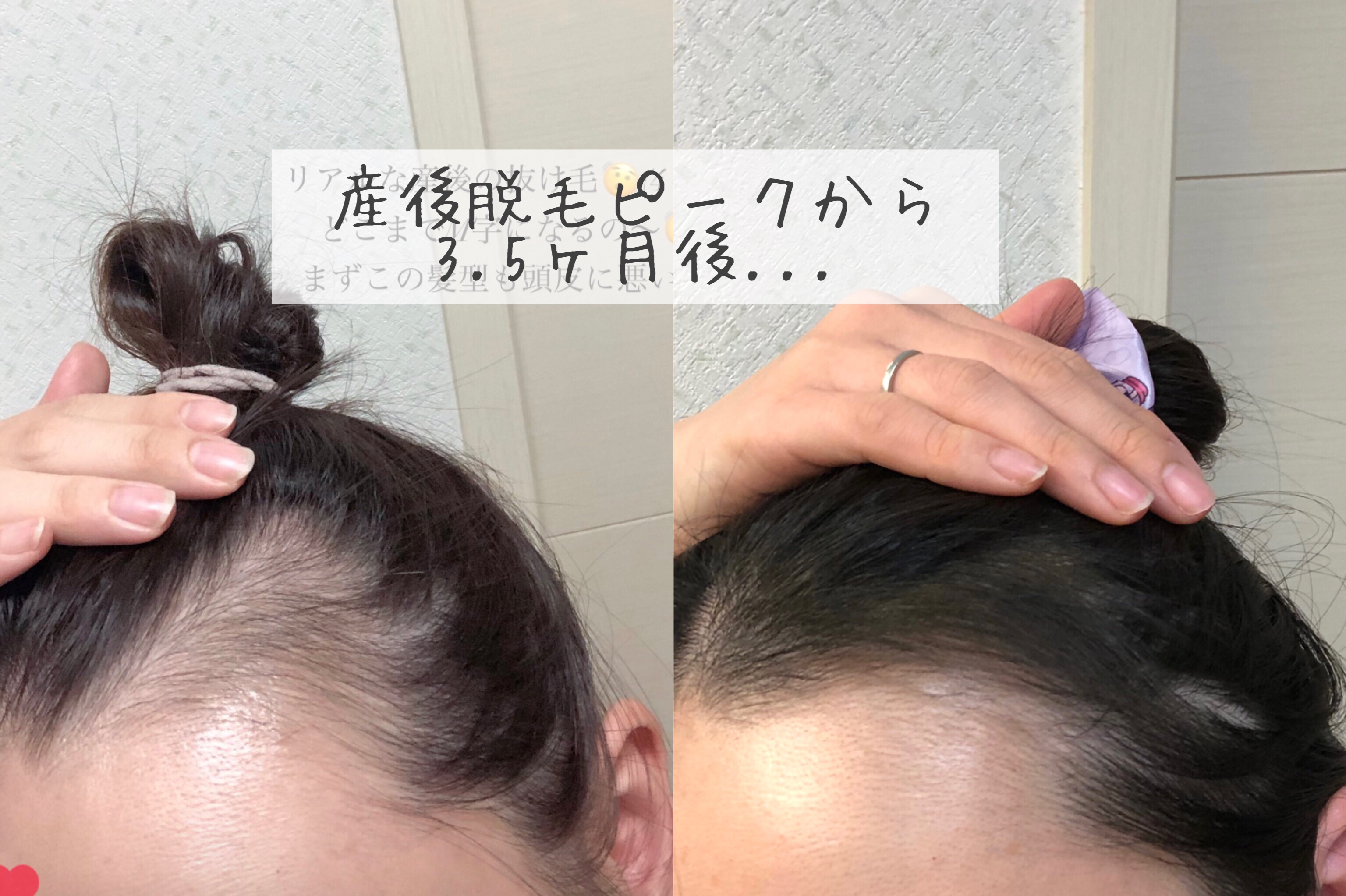 ふわ姫＜医薬部外品＞/ソーシャルテック/頭皮ローションを使ったクチコミ（1枚目）