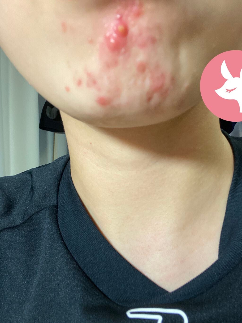 のの on LIPS 「お久しぶりです。一向にニキビが良くならないです。何かいいスキン..」(3枚目)