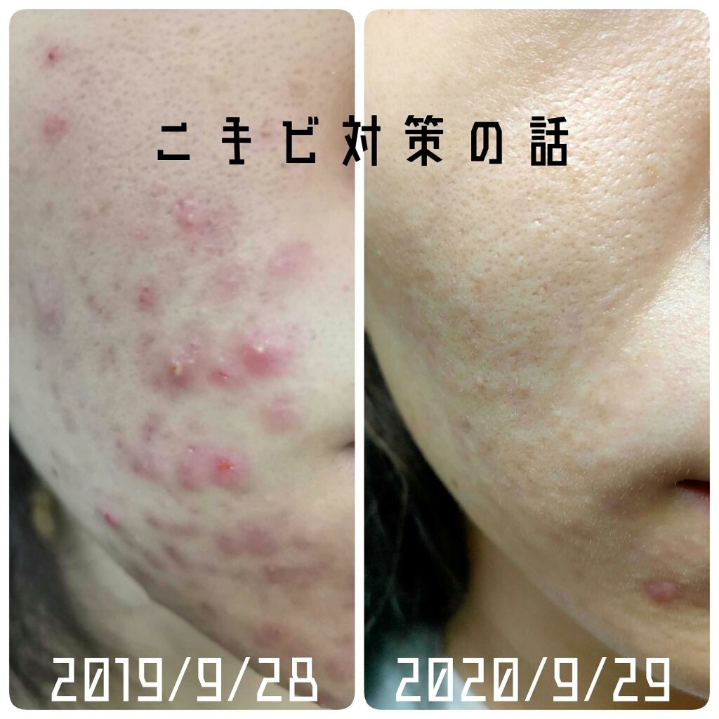 ペアアクネクリームW(医薬品)/ペア/その他を使ったクチコミ（2枚目）