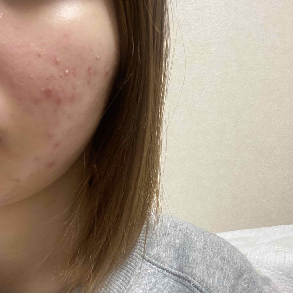 クリンダマイシンゲル(医薬品)/クラシエ薬品/その他を使ったクチコミ（2枚目）