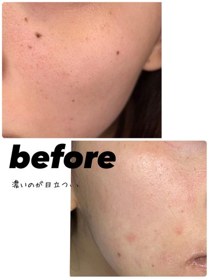 EUKROMA ハイドロキノンクリーム4% 20g/EUKROMA/その他スキンケアを使ったクチコミ(2枚目)