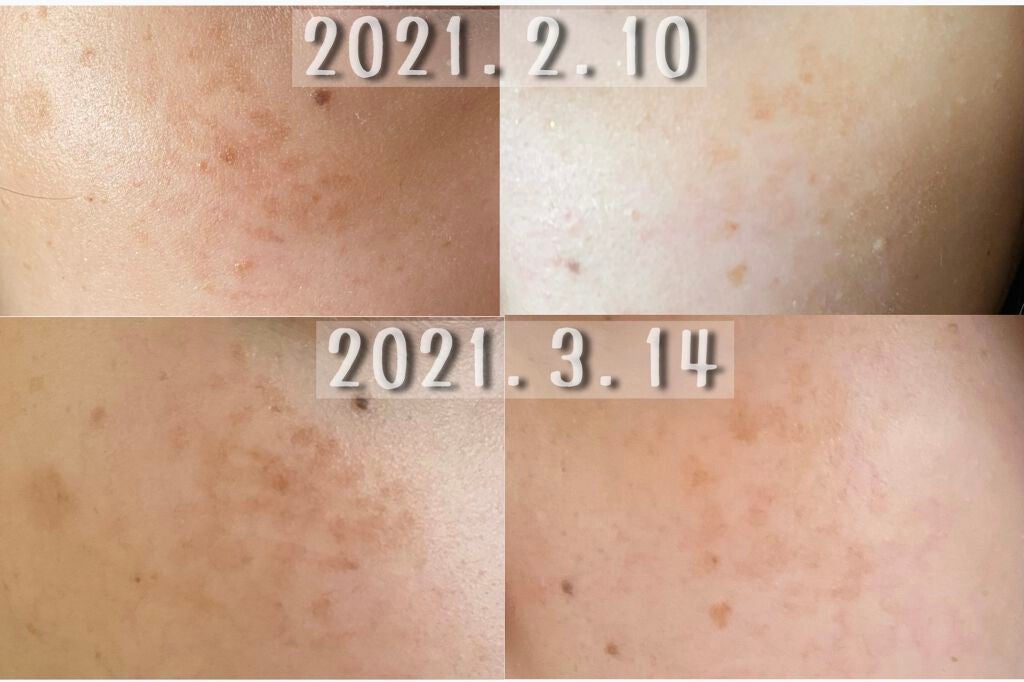 ホワイトCクリア(医薬品)/トランシーノ/その他を使ったクチコミ(2枚目)