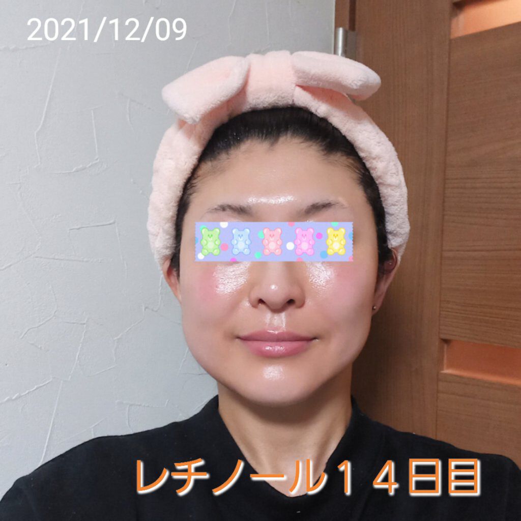 トレチノインジェル/A-Ret/美容液を使ったクチコミ（1枚目）