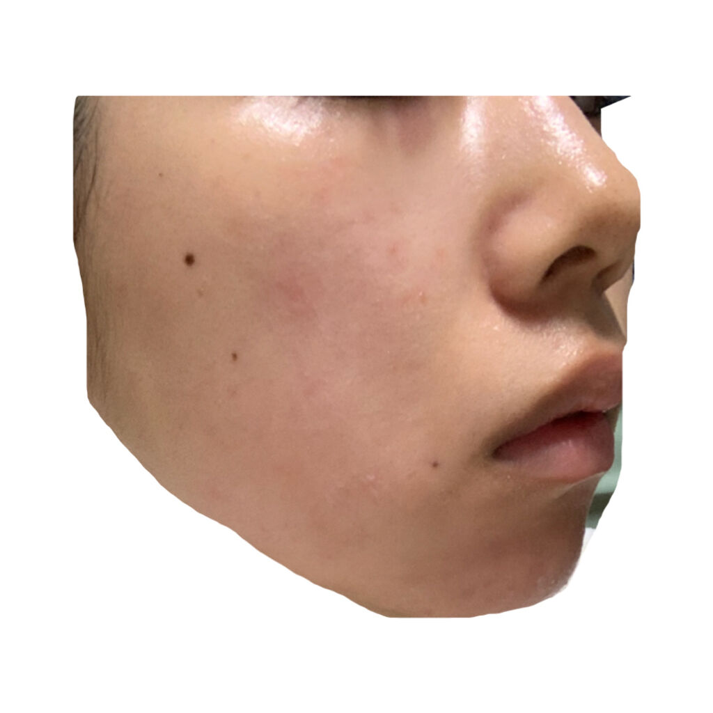 ベピオゲル/マルホ株式会社/その他を使ったクチコミ（2枚目）