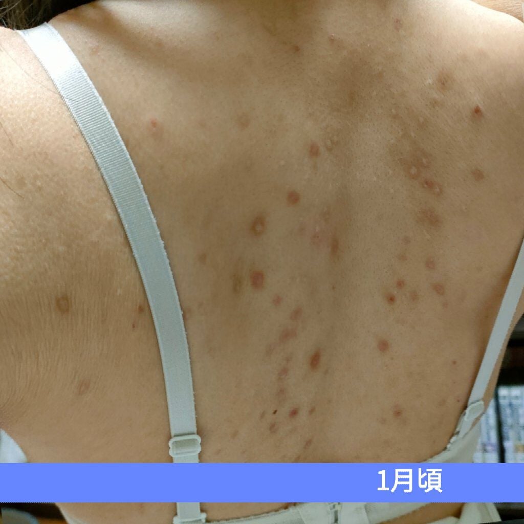 coral_gloss_gdz on LIPS 「背中キレイキレイダイアリー④お久しぶりです。今回はキレイキレイ..」(3枚目)