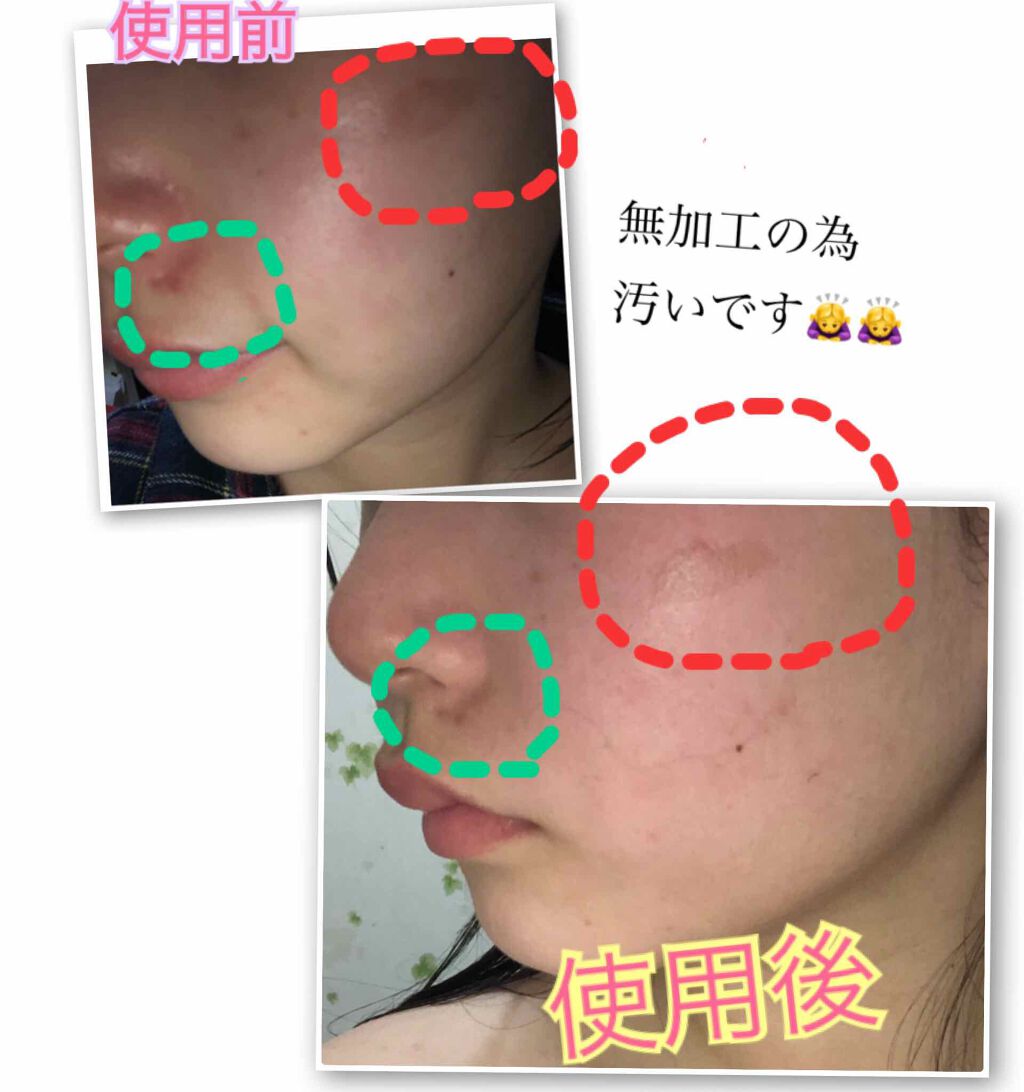 バイオイル/バイオイル/フェイスオイルを使ったクチコミ（2枚目）