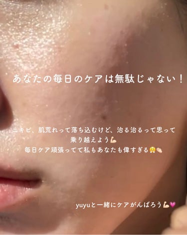 yuyu🐶肌荒れ体質の正直レビュー on LIPS 「【ニキビ跡ケア🔥やめてよかった6つのコト】✼••┈┈••✼••..」（8枚目）