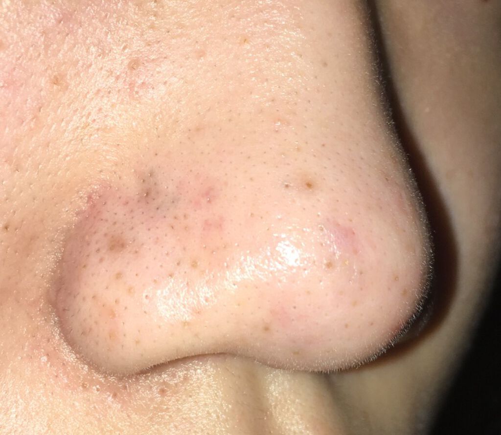 ãã
ãð on LIPS ãæ¯ç©Žè©°ãã©ãã«ããããïŒïŒç§ã¯åçã®éãæ¯ç©Žè©°ããé
·ãã§ããã..ãïŒ3æç®ïŒ