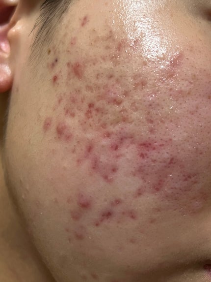 部活jk on LIPS 「助けてください!!!皮膚科に通い始めて、2ヶ月が経とうとしてい..」(1枚目)