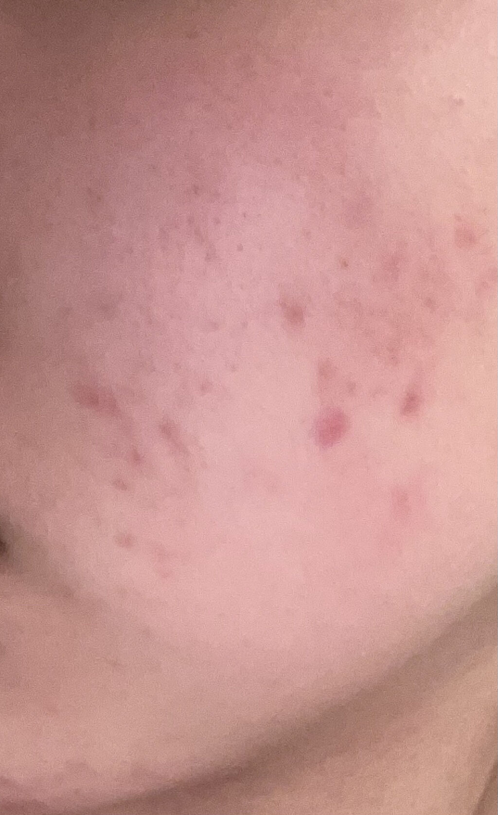 ニキビあとケアジェル/アットノン/その他スキンケアを使ったクチコミ（1枚目）