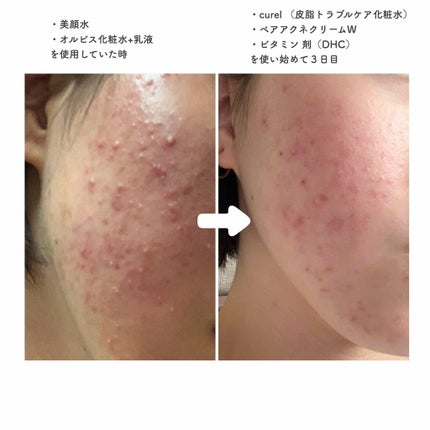 皮脂トラブルケア ミニセット/キュレル/スキンケアキットを使ったクチコミ(1枚目)