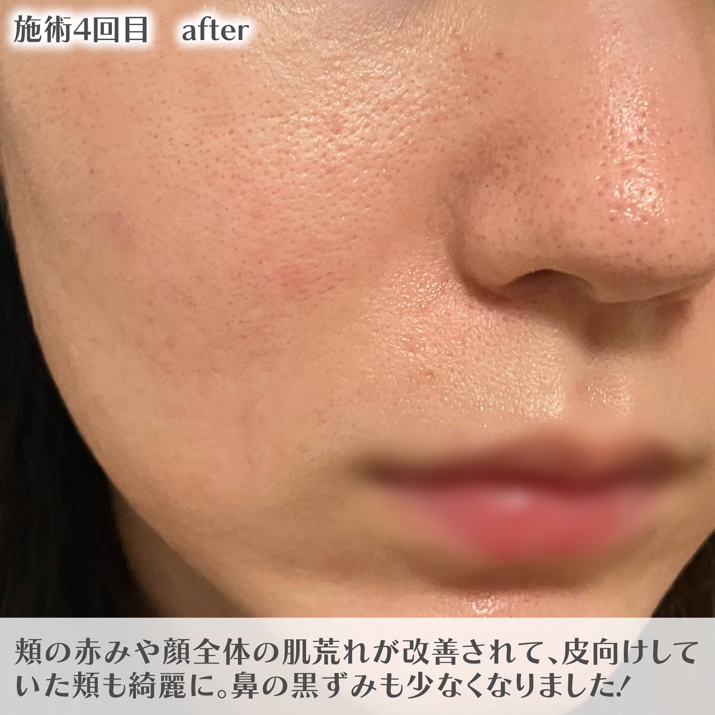 甘皮 on LIPS 「【肌荒れ治療記】美容クリニックに通ってみた結果線の内側は前置き..」(3枚目)